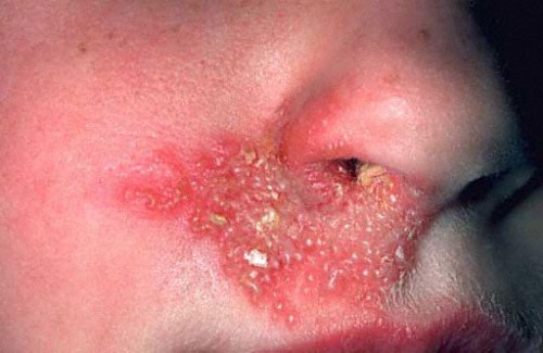 Signs Of Herpes On Lips